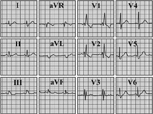 ECG answer 3