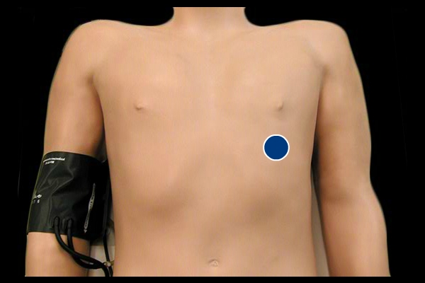 Precordial Impulse - normal location and enlarged