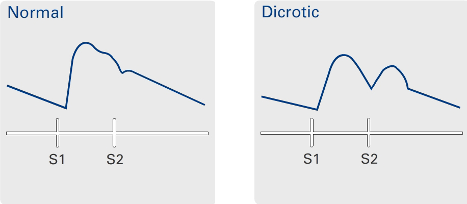 Dicrotic