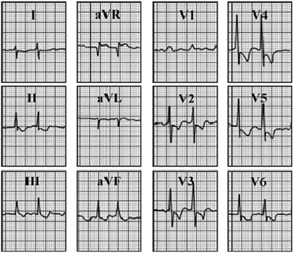 ECG answer 3