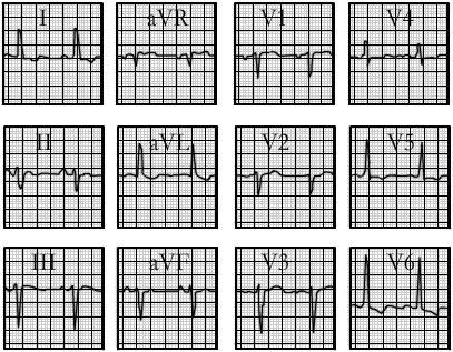 ecg