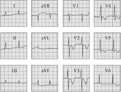 ECG answer 3