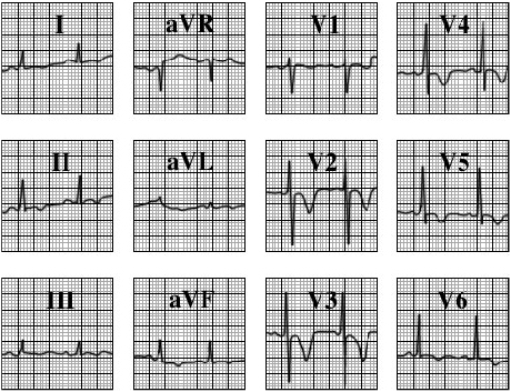 ECG answer 3