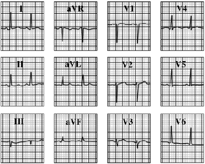 ECG answer 3