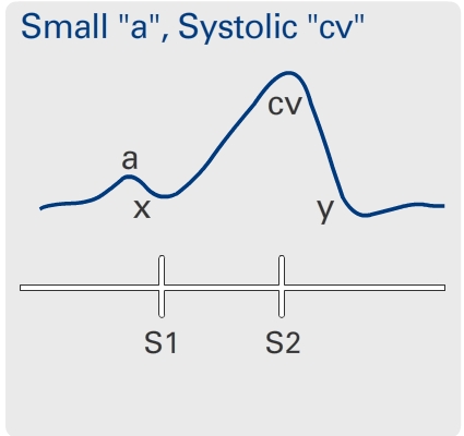 Hypokinetic