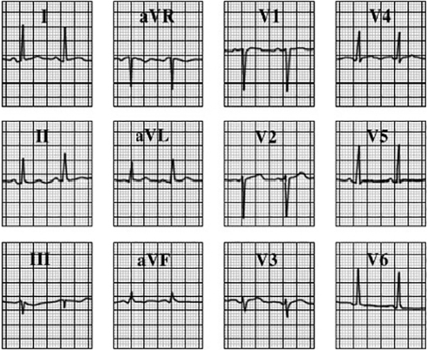 ECG answer 3