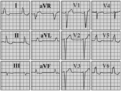 ECG answer 3