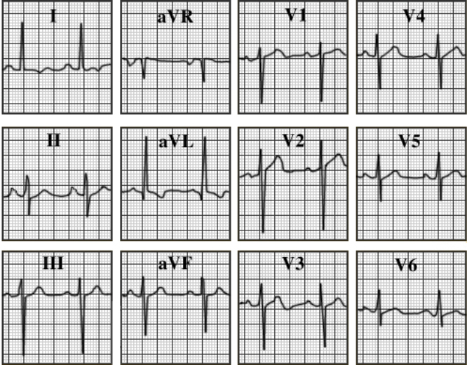 ECG answer 3