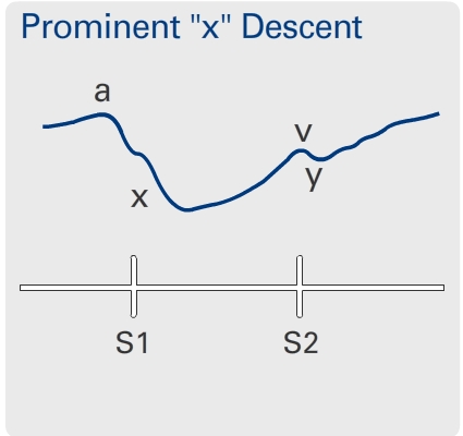 Prominent 'x' descent