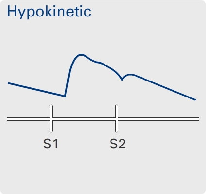 Hypokinetic