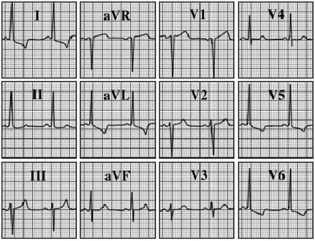 ECG answer 3